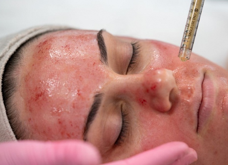 PRP for the face - Reine Medico-Aesthetics PRP for the face - Reine Medico-Aesthetics